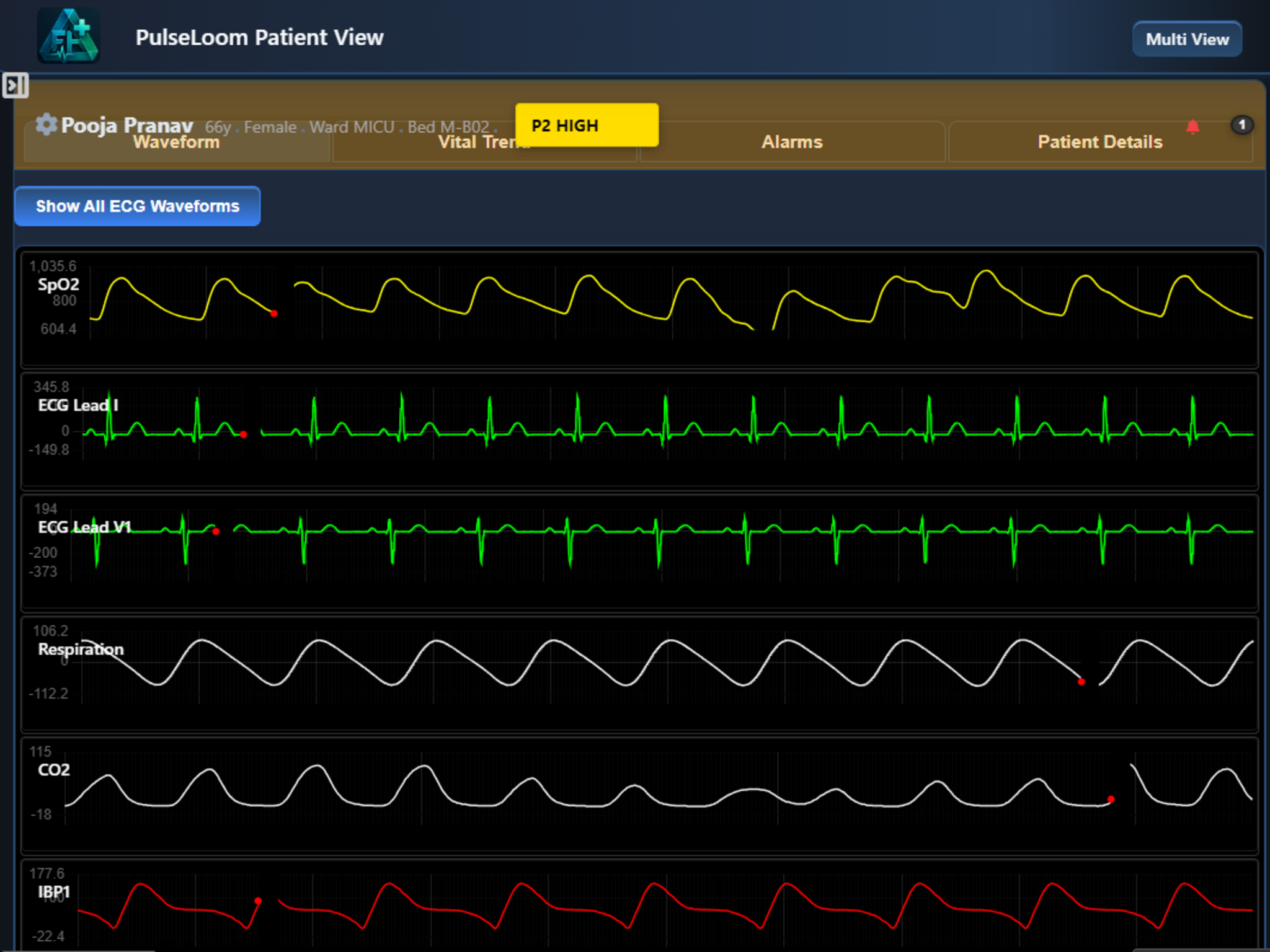 PulseLoom single patient view – waveforms & trends